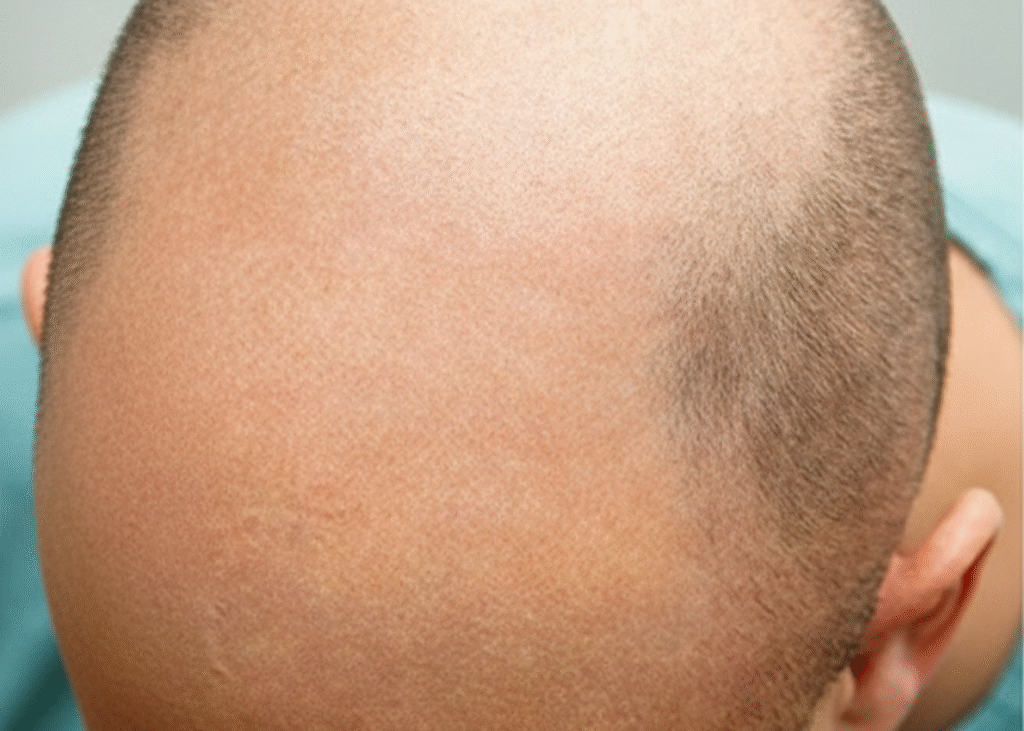 ترقق الشعر في مقدمة الرأس ضمن تقييم الاستعداد لزراعة الشعر