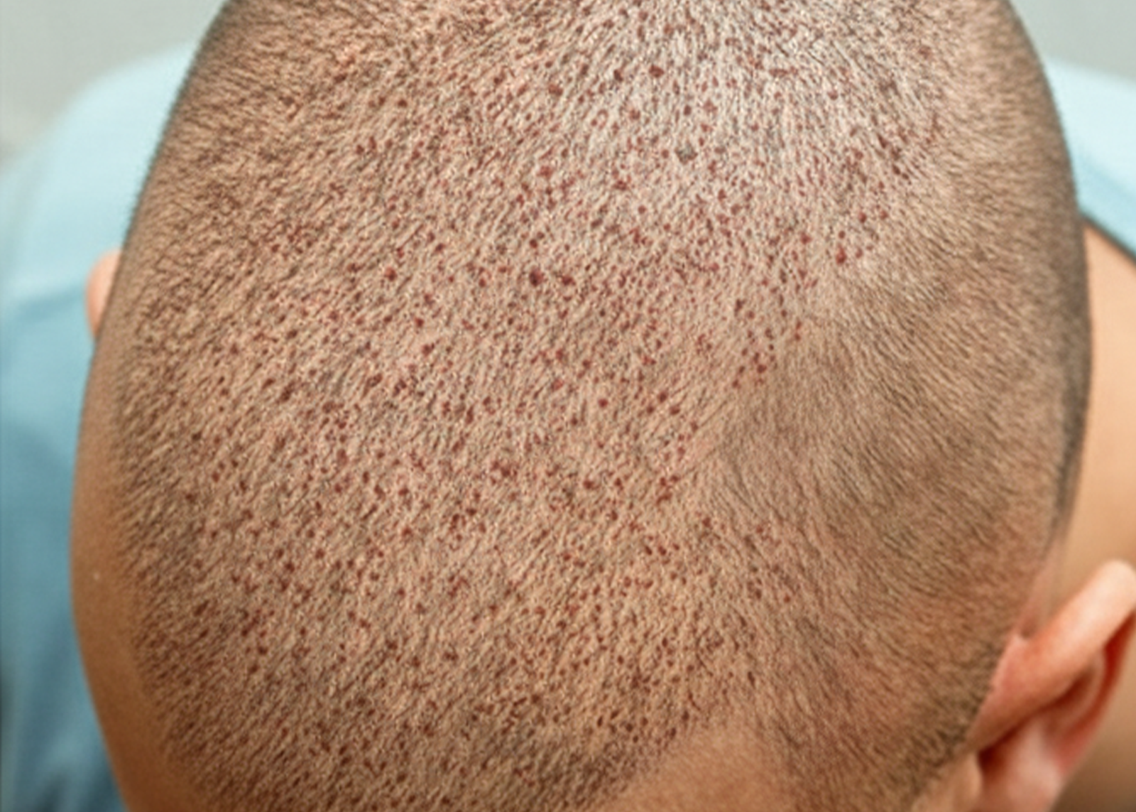 زراعة الشعر غاليا روتس2